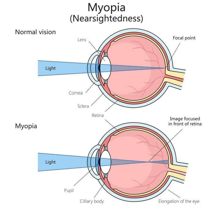 Diagram compares light refracting in a normal eyeball to a myopic eyeball, where the focal point is in front of the retina.
